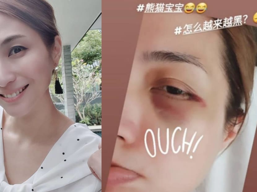 Vivian Lai Now Has A Bruised “Panda Eye” After Falling Down In The Middle Of The Night