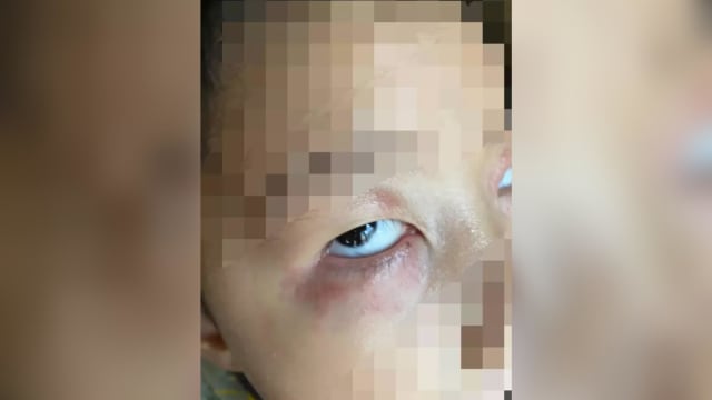 台湾五岁童染冠病 “生蛇”绕眼一圈急送医