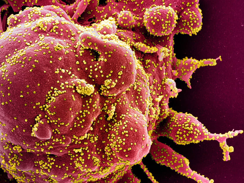 A handout image obtained on April 29, 2020 and released by the National Institute of Allergy and Infectious Diseases (NIAID) of the National Institutes of Health (NIH), shows a colorised scanning electron micrograph of an apoptotic cell (red) heavily infected with Covid-19 particles (yellow), isolated from a patient sample captured at the NIAID Integrated Research Facility in Fort Detrick, Maryland.