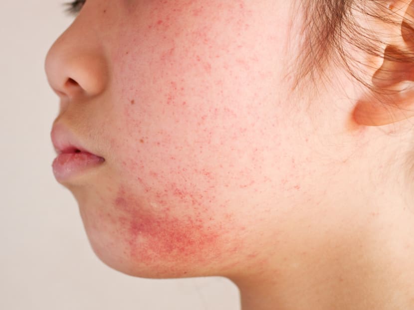Severe eczema drug is approved by FDA; Price tag is US$37,000 a year