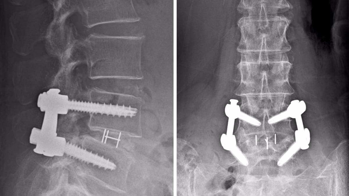 Keyhole Spine Surgery Saved 79 Year Olds Back And Sanity Today 2604