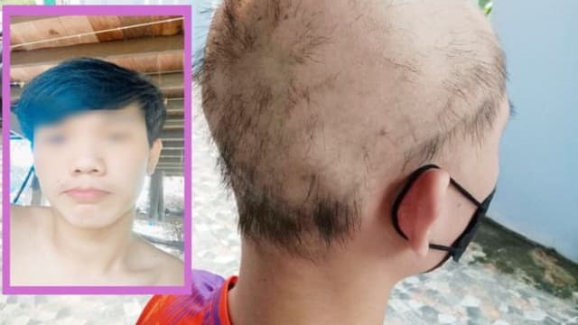 泰国少年打完两剂疫苗 狂掉头发惨变秃头