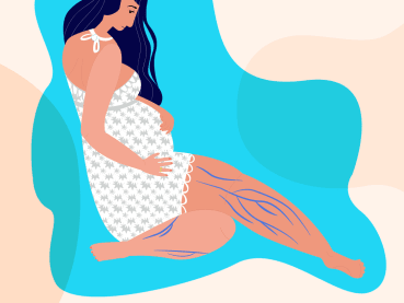 Varicose veins aren’t just unsightly but could also be a health risk – why do women still ignore them?