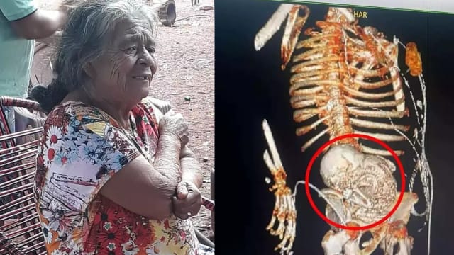 体内藏石胎56年 巴西八旬老妇手术后身亡