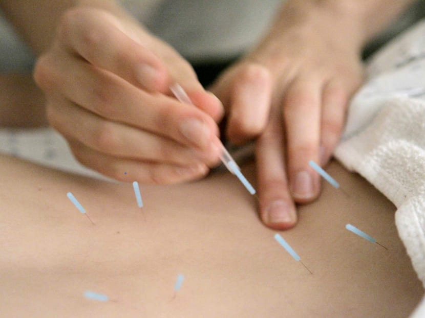 Acupuncture needles being used to relieve lower back pain. AP file photo
