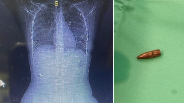背痛误当肌肉拉伤 以色列女子三个月后发现自己中枪