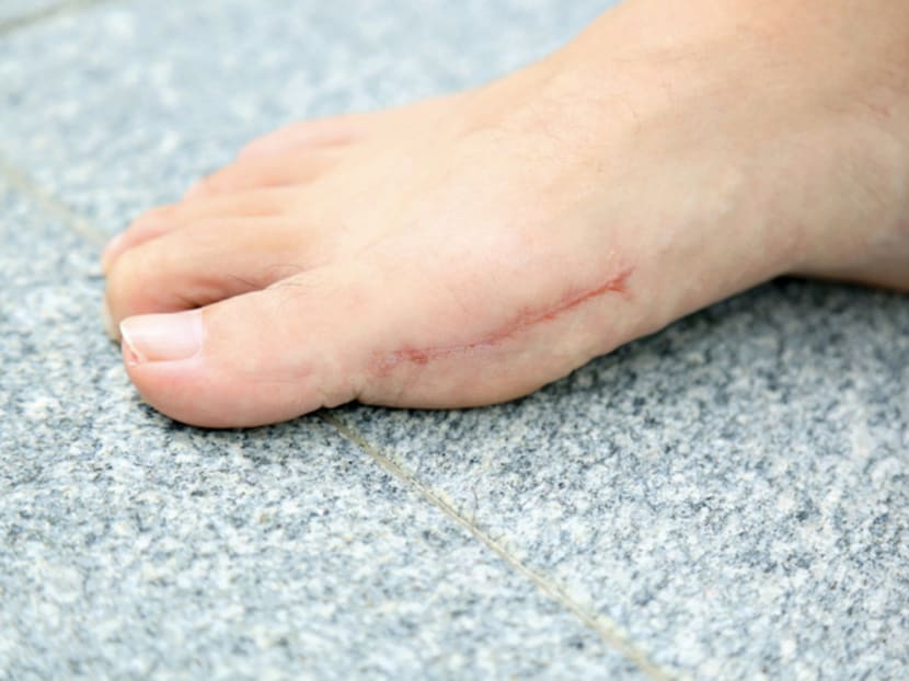Bunion surgery now offers more pros than cons