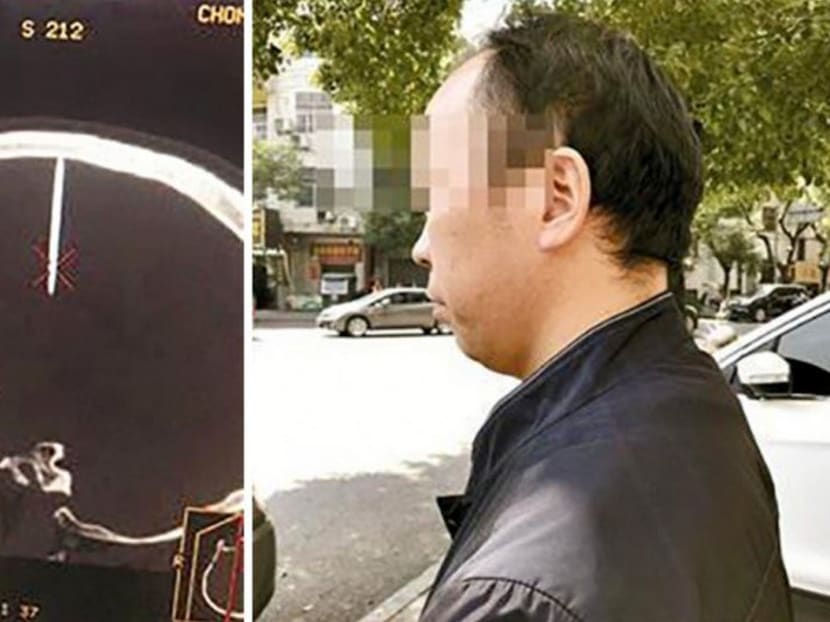 After they did a CT scan, doctors at the Chongyang People’s Hospital were shocked to discover a nail hanging from the right side of the man’s skull, according to the report.