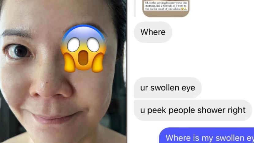 Michelle Chong Has A Horrifying Swollen Eye; Gives Hilarious Reply To Follower Who Asked If She Peeped At Someone In The Shower