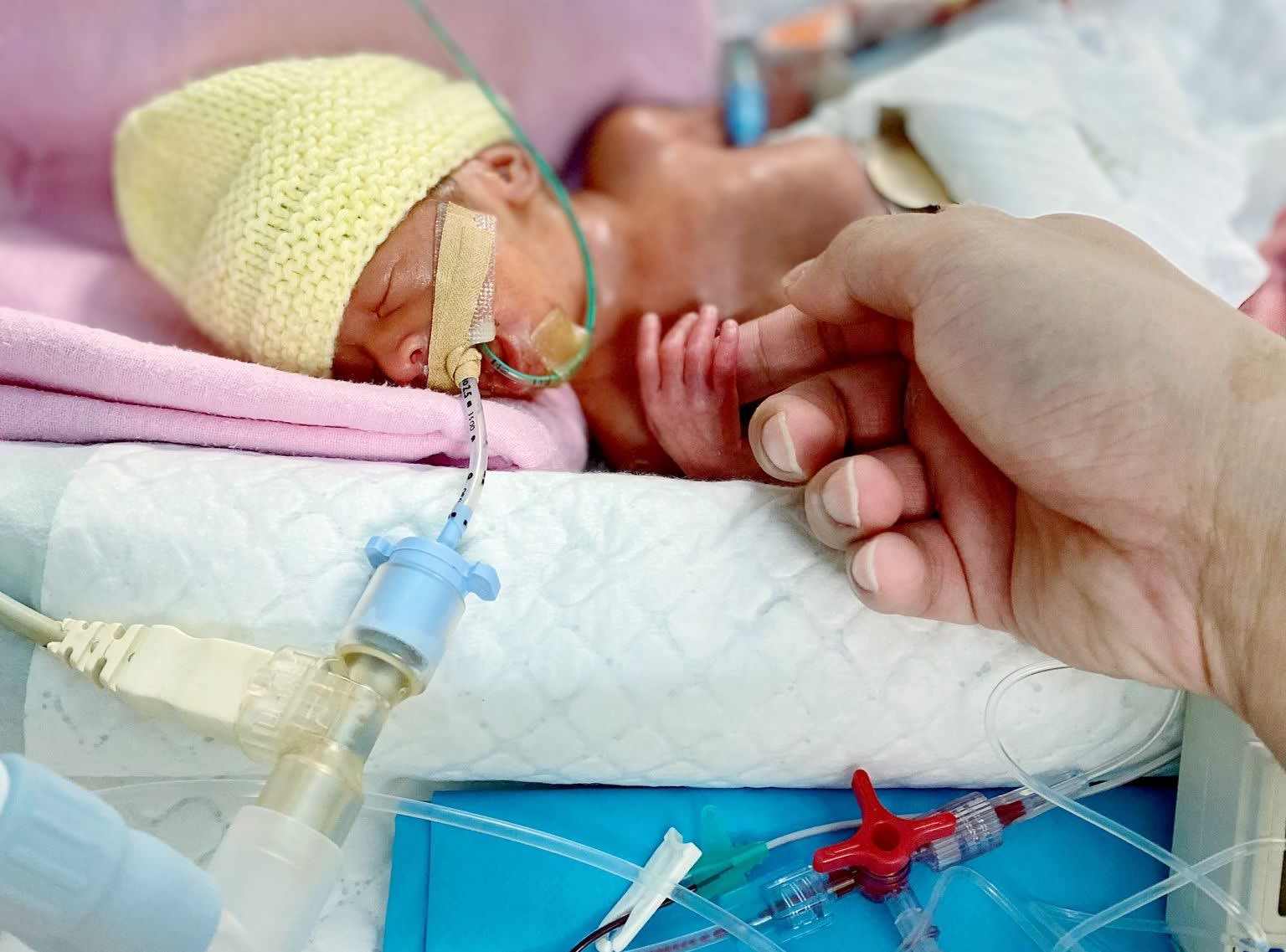 Premature baby ‘size of a palm’ home after 400 days in KKH, parents learn to rise above heartache Premature baby ‘size of a palm’ home after 400 days in KKH, parents learn to rise above heartache