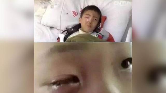 玩干燥剂引爆炸 中国男童右眼球“整个被溶解”