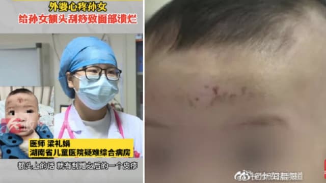 中国女婴久咳未愈 外婆给她刮痧驱寒导致面部溃烂