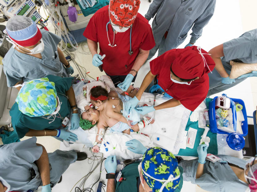In this undated photo provided by the Texas Children’s Hospital, doctors work to separate 10-month-old conjoined twin girls at Texas Children's Hospital in Houston. Photo: AP