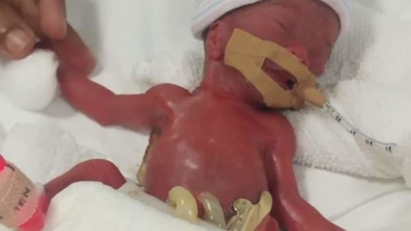 World s smallest baby born at 212 grams at NUH now doing well at