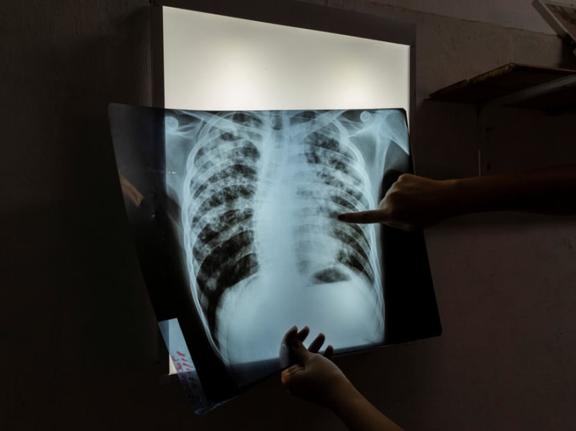 Tuberculosis is a curable airborne disease, with treatment rapidly reducing transmission. Tuberculosis is a curable airborne disease, with treatment rapidly reducing transmission.