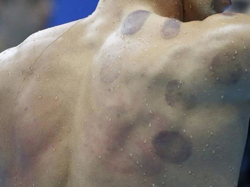 Cupping marks on American swimmer Michael Phelps' back in 2016. Cupping marks on American swimmer Michael Phelps' back in 2016.