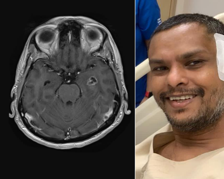 Man remarries wife after removal of brain tumour that was likely cause of behaviour change, family break-up Man remarries wife after removal of brain tumour that was likely cause of behaviour change, family break-up