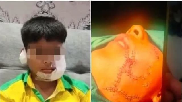 印度十岁男童被狗咬伤 需缝150针