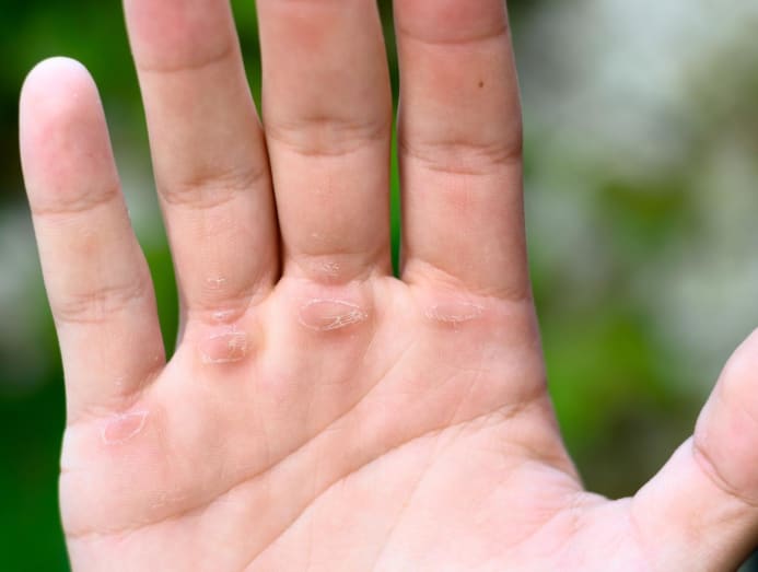 How to Get Rid of Calluses On Your Hands from Lifting Weights