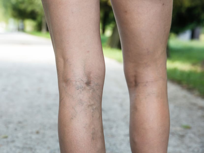 Experiencing painful, heavy periods? You might have varicose veins in the pelvic area