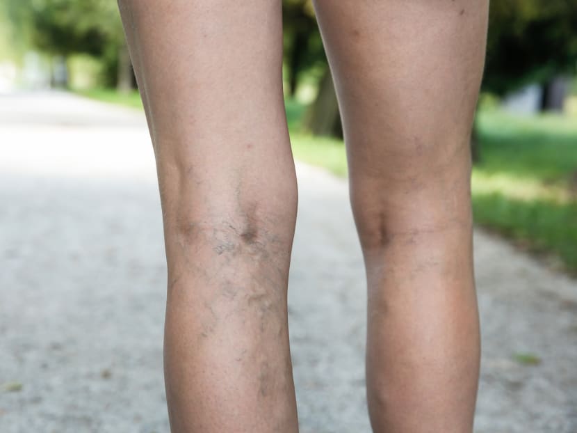 Experiencing painful, heavy periods? You might have varicose veins in the pelvic area Experiencing painful, heavy periods? You might have varicose veins in the pelvic area