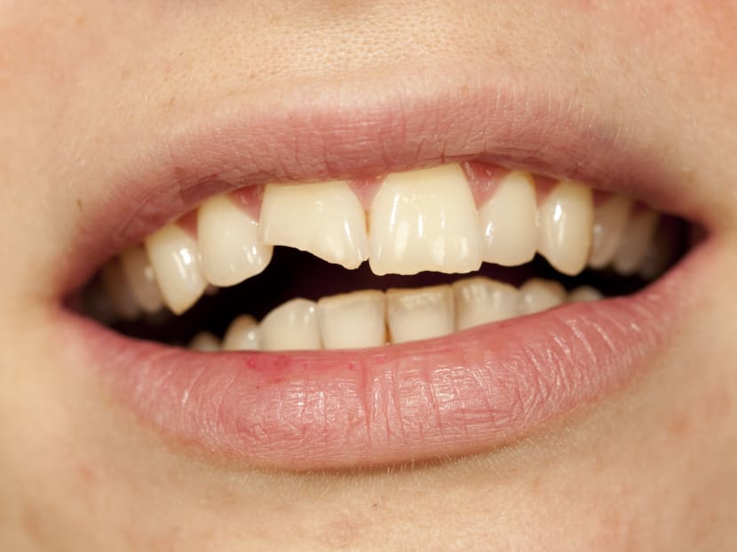 Time to chew slowly: How eating economy rice can lead to broken teeth Time to chew slowly: How eating economy rice can lead to broken teeth
