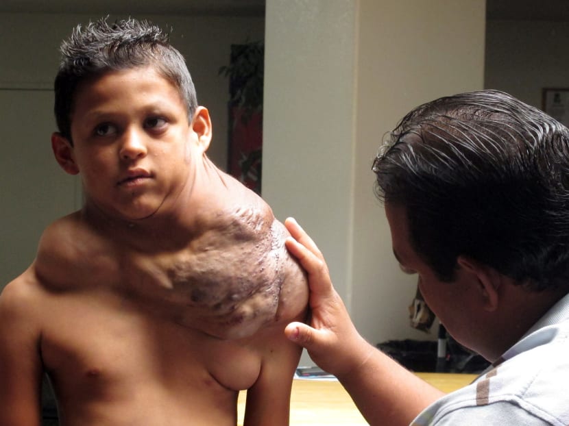 Mexican boy has massive tumour removed in US