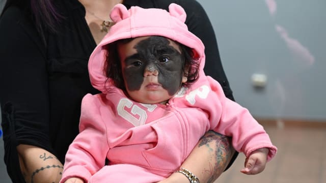 脸上黑痣犹如蝙蝠侠面具 患罕见皮肤病美国女婴赴俄治疗