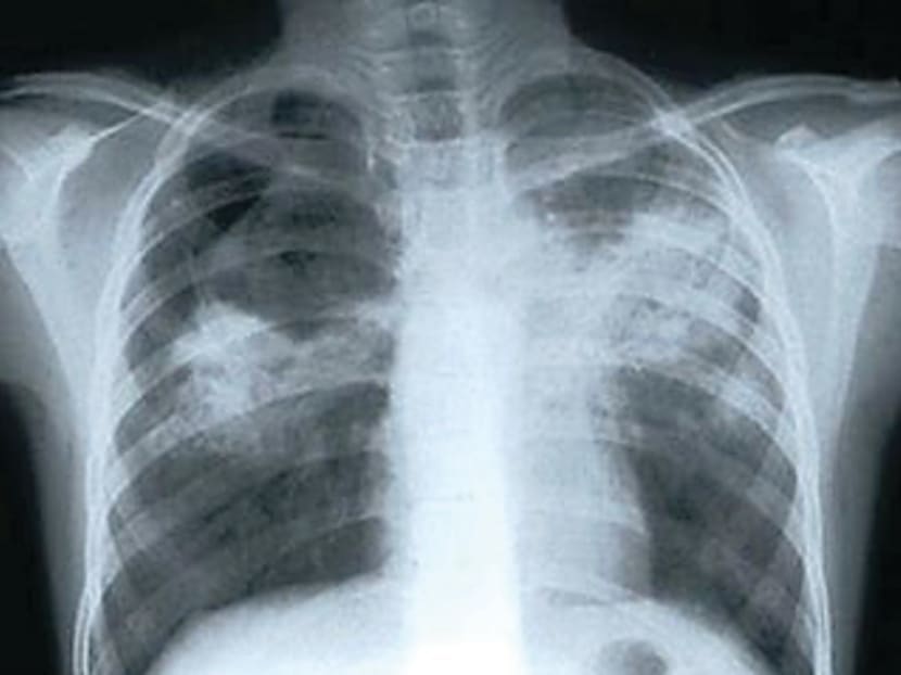 An x-ray showing lungs affected by tuberculosis. TODAY file photo