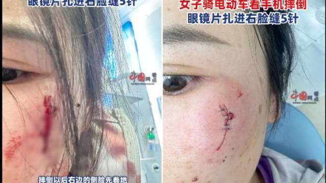 骑车时看手机 中国女子摔倒镜片扎进脸