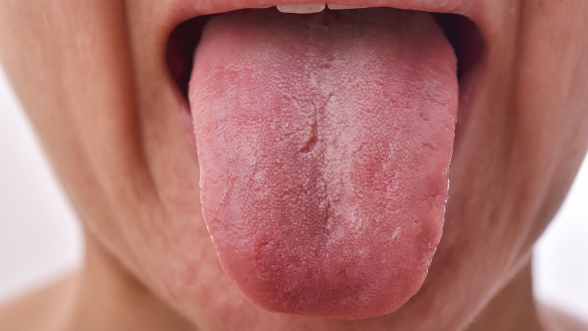 sendt udstødning Vild What's that white coating on your tongue? How to tell if you're healthy or  not - CNA Lifestyle
