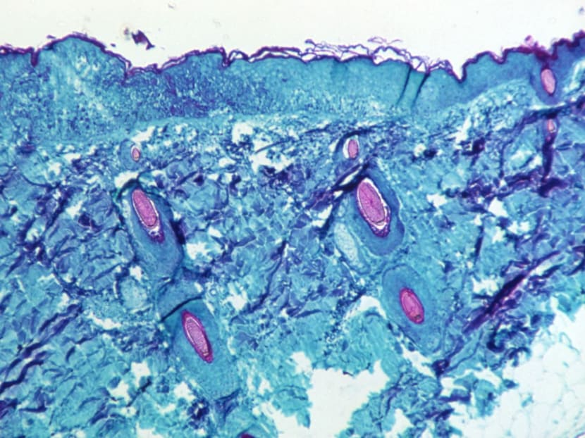 UK designates monkeypox as a notifiable disease UK designates monkeypox as a notifiable disease