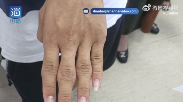 中国15岁少年爱掰手指 导致指节变形和膨大