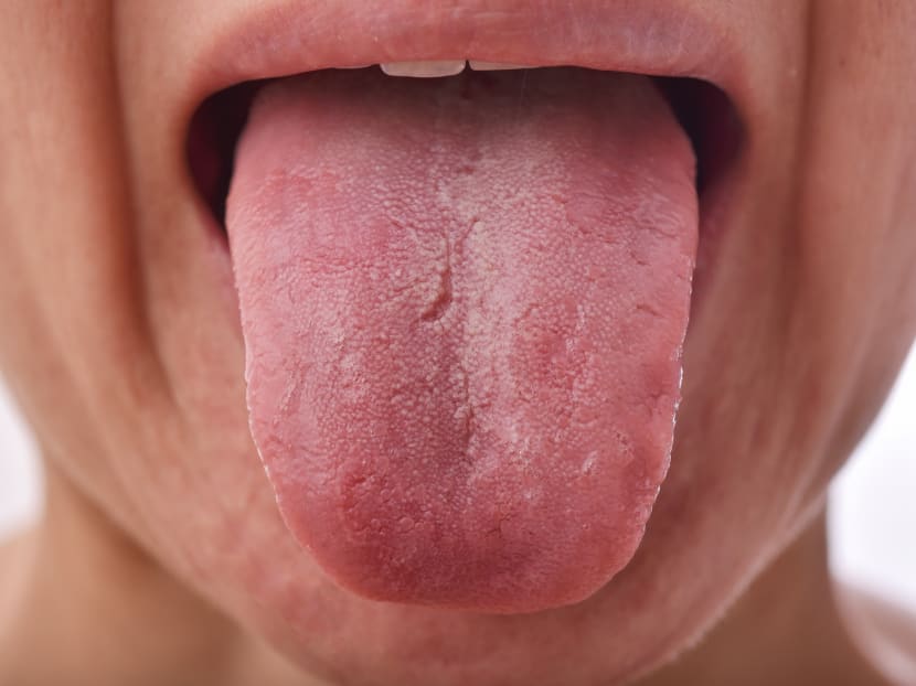 What’s that white coating on your tongue? How to tell if you’re healthy or not