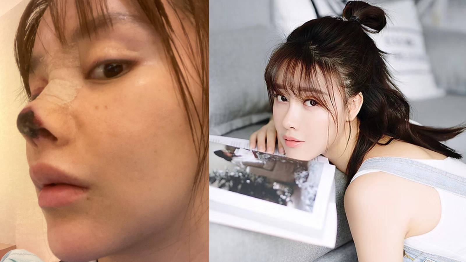 Chinese Actress Gao Liu’s Nose Job Went So Horribly Wrong, The Tip Of Her Nose Turned Black