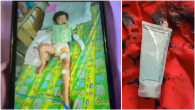 兄弟玩搓手液点打火机 泰国幼童全身着火