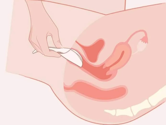 Trying To Get Pregnant? This Device Minimises Sperm Leak To Boost Your  Chances - Cna Lifestyle