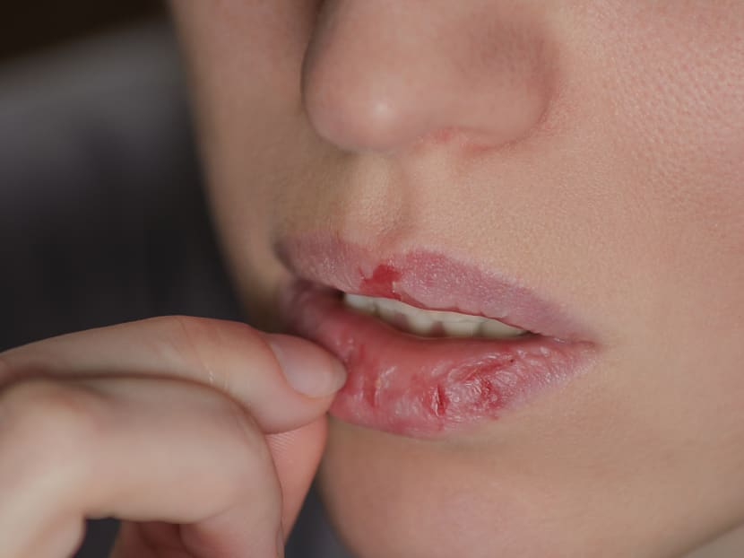 Do you habitually pick at your skin? You could be suffering from excoriation disorder Do you habitually pick at your skin? You could be suffering from excoriation disorder