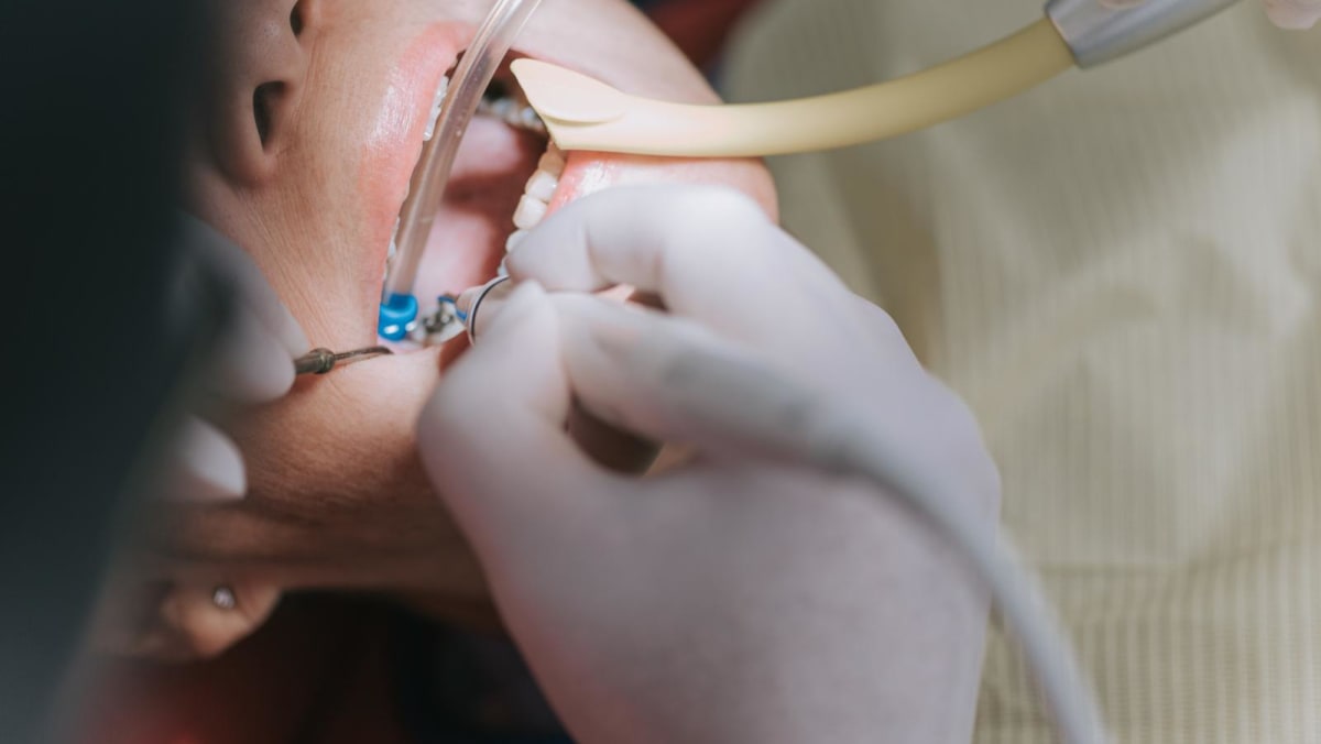 ‘Takes time and experience to do well’: Why root canal treatments can cost thousands of dollars ‘Takes time and experience to do well’: Why root canal treatments can cost thousands of dollars