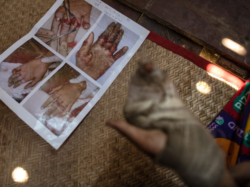 14-year-old San Min Hteik, 14, shows his injured hand during an interview at his home in the Myaung Dakar industrial zone in Hmawbi. Phoho: AFP