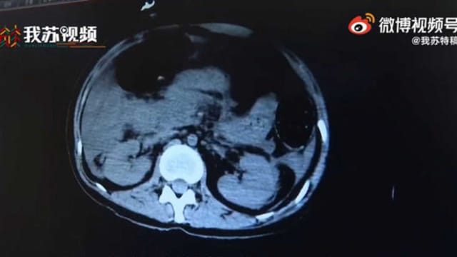 水果和红酒代替主食 中国女子血糖“爆表”不治