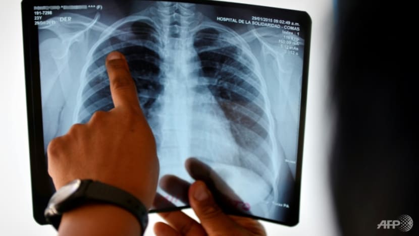 1,370 tuberculosis cases in Singapore in 2020, lowest in more than 10 years