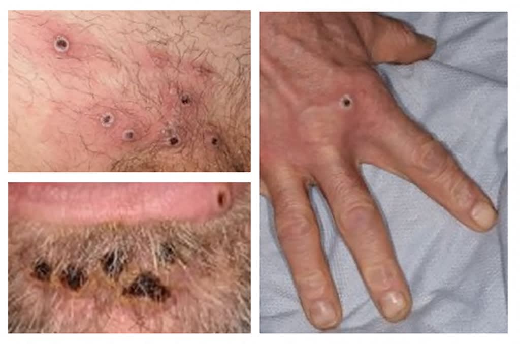 In this file handout photo taken on June 22, 2022 made available by the UK Health Security Agency (UKHSA) shows a collage of monkeypox rash lesions at an undisclosed date and location. In this file handout photo taken on June 22, 2022 made available by the UK Health Security Agency (UKHSA) shows a collage of monkeypox rash lesions at an undisclosed date and location. 