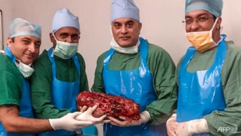 Indian doctors remove giant 7.4kg kidney from man Indian doctors remove giant 7.4kg kidney from man