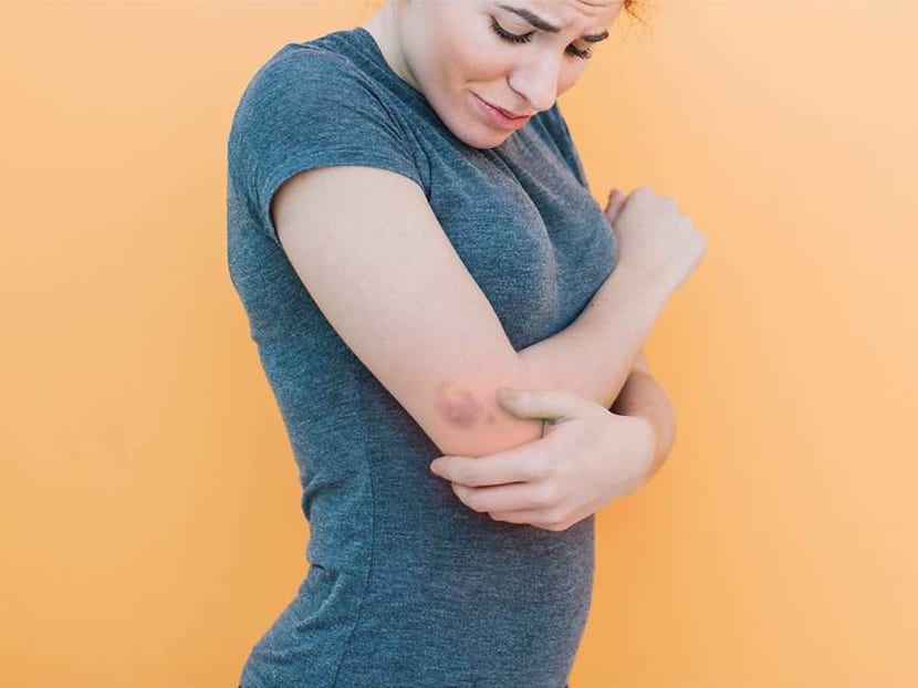 Why do some people get bruises easily – and when should you go see a doctor? Why do some people get bruises easily – and when should you go see a doctor?