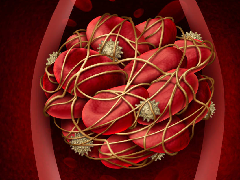 An illustration of a blood clot in a blood vessel. Some people with pre-existing chronic diseases such as diabetes or who are obese are more likely to require intensive care treatment and tend to have worse outcomes when they get Covid-19.
