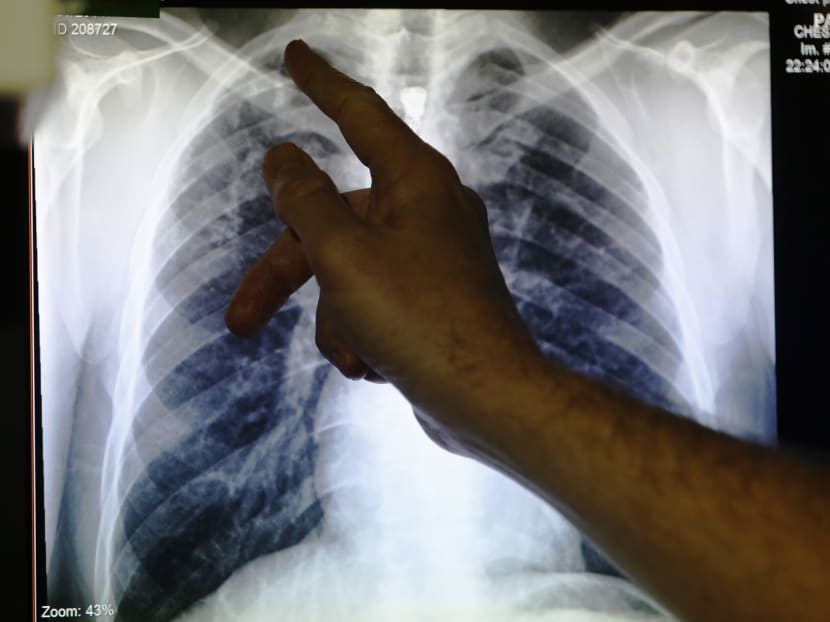 Tuberculosis is a curable airborne disease, with treatment rapidly reducing transmission.