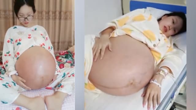 中国年轻妈妈怀三胞胎 孕肚大到出行得坐轮椅