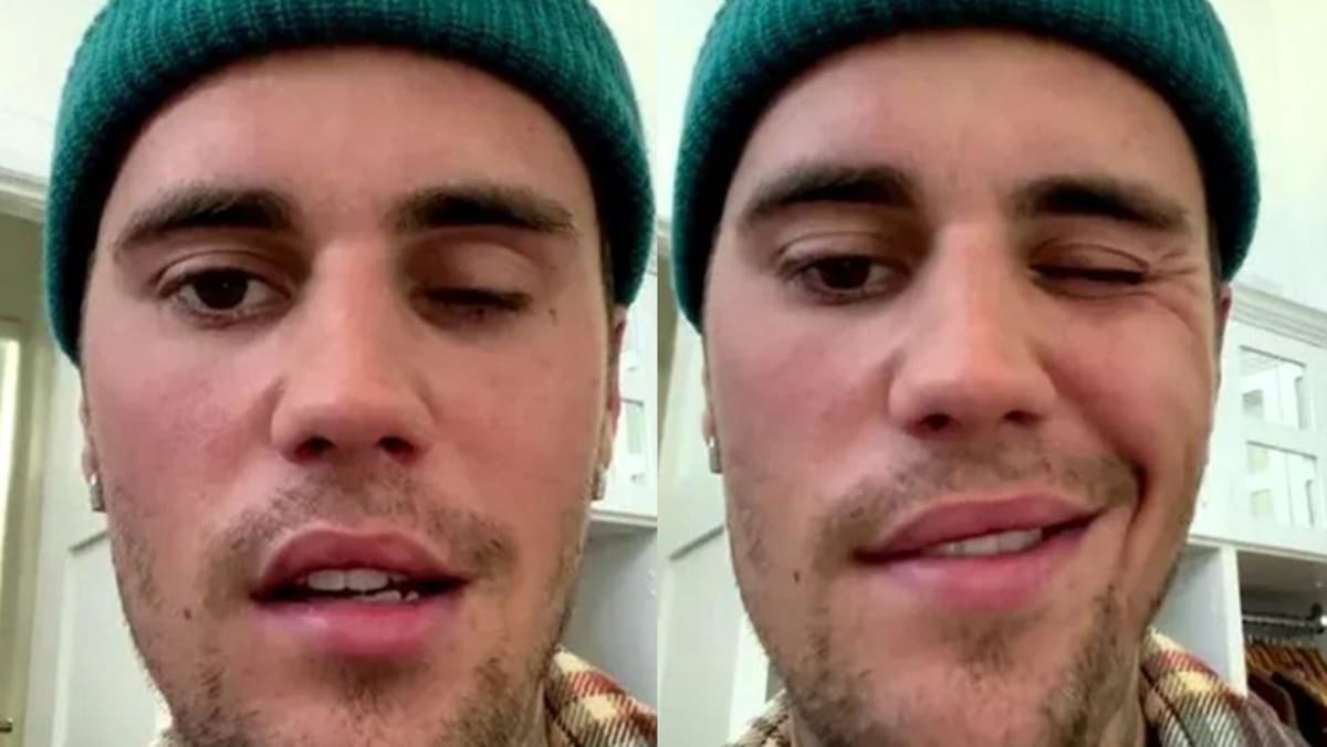 What’s the link between chickenpox and Justin Bieber’s facial paralysis ...