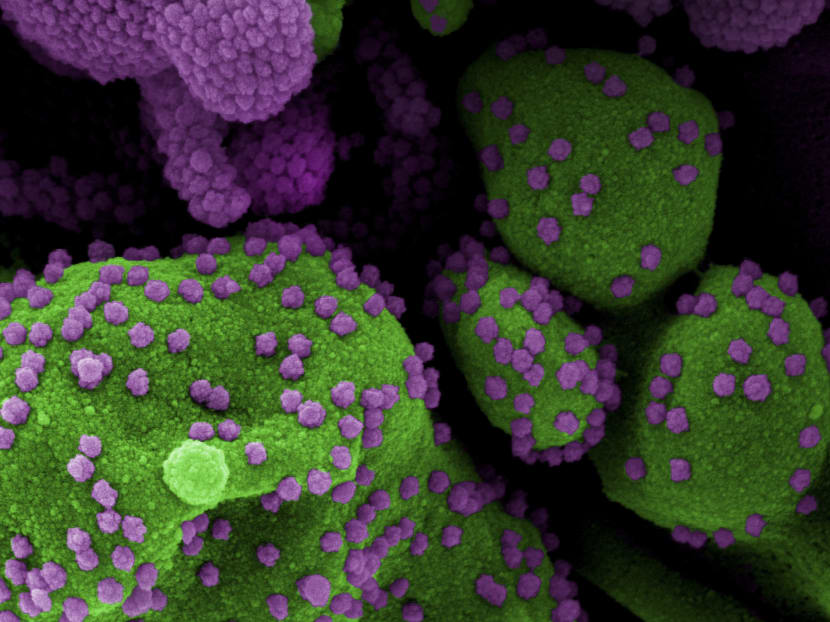 A colorised scanning electron micrograph of an apoptotic cell (green) heavily infected with coronavirus particles (purple), isolated from a patient sample, at the National Institute of Allergy And Infectious Diseases (NIAID) Integrated Research Facility in Fort Detrick, Maryland.